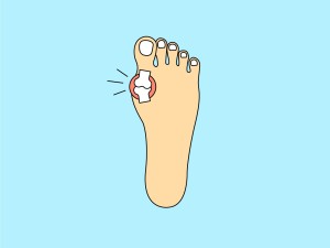 Illustration Hallux valgus